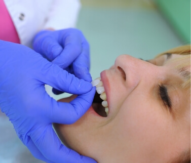 Dentist placing a veneer over a tooth
