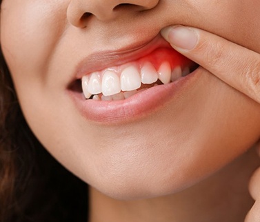 a woman showing signs of gum disease