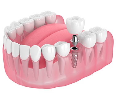 Illustration of dental implant