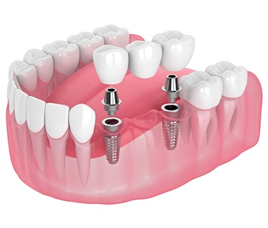 Illustration of a dental bridge
