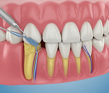 A CGI image of scaling and root planing treatment