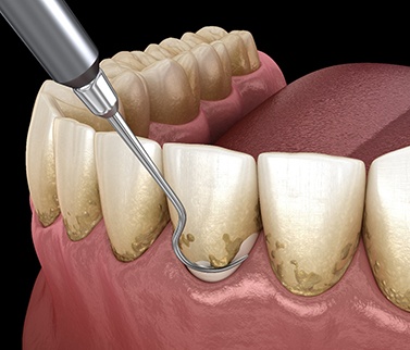 A CGI image of teeth getting scaling and root planing treatment