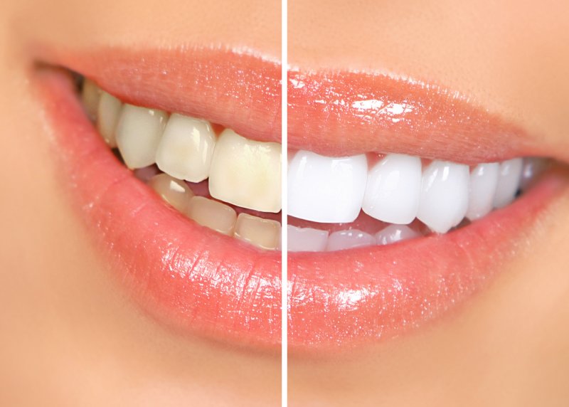 Teeth before and after whitening