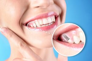 Nose-to-neck view of woman touching face smiling with a tooth indicated as an implant